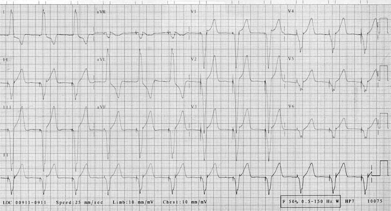 Which of the following is the most likely explanation for the findings shown on the ECG recording obtained one hour after a 45-yearold man underwent implantation of a pacemaker?