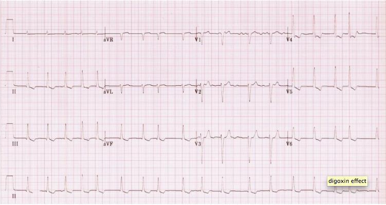 Question 2 Which drug is likely to have resulted in these ECG