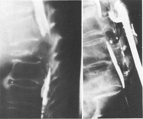 Stabilization of pathological spine fractures FIG. 1. Left: Anteroposterior x-ray film of the lumbar spine showing collapse of the L-4 vertebra due to multiple myeloma.