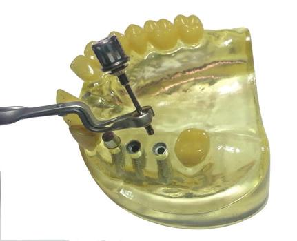 Implant Abutment 90 In-line
