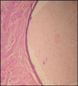 12: 40X CONCLUSION: In the present case, multiple sections studied revealed endometrial tissue emboli