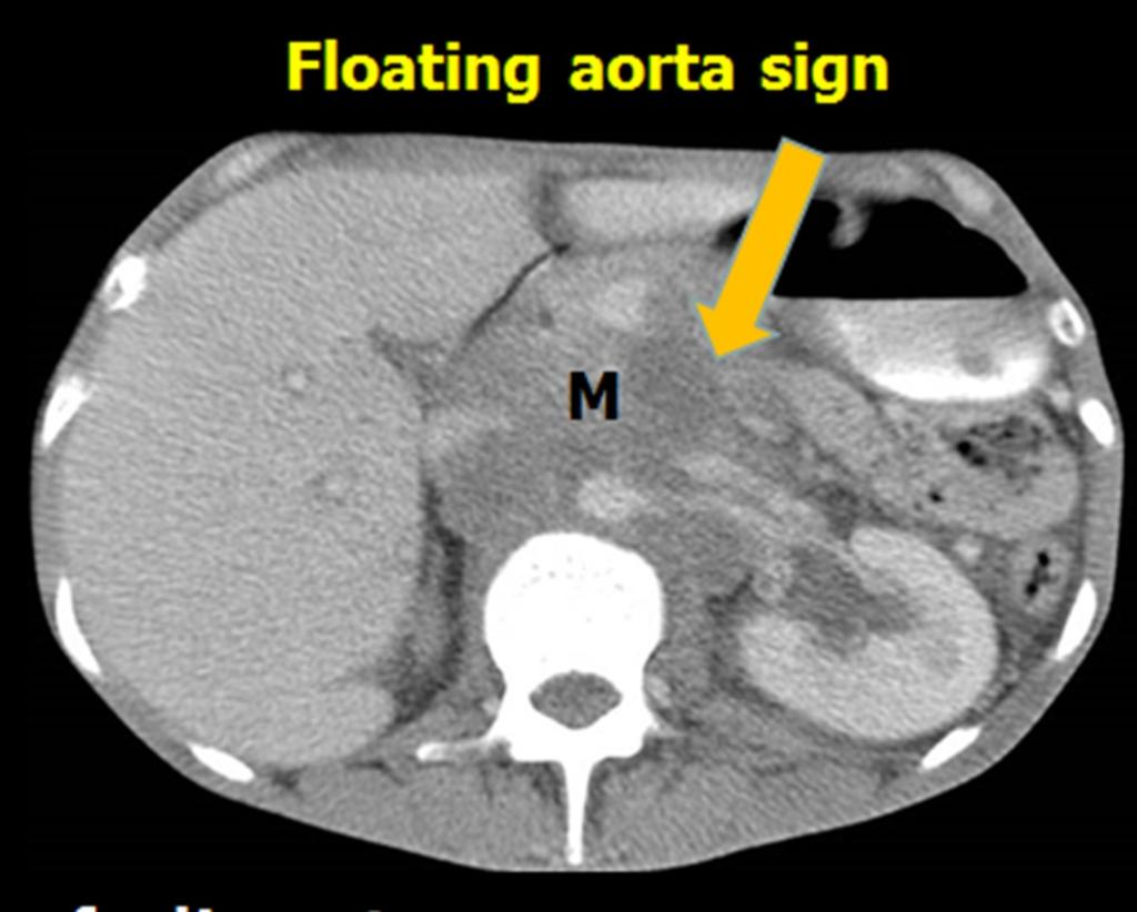 Fig. 15: Oblique sagittal CECT image demonstrating encasement and Infiltration of the left ureter by the mass causing left