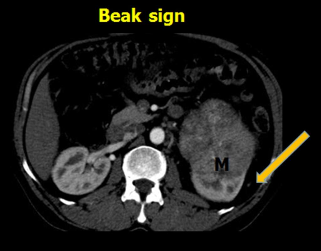 Fig. 18: Axial CECT image of left renal cell carcinoma demonstrating
