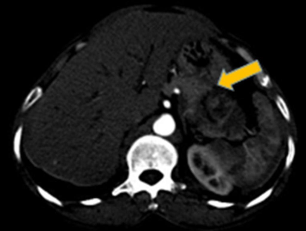 Fig. 19: Axial CECT image with beak sign demonstrated