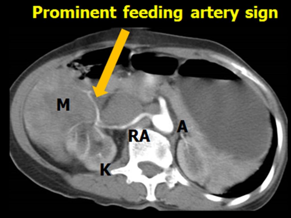 Fig. 23: Oblique sagittal CECT image of a case of left psoas abscess demonstrating embedded organ sign. Fig.