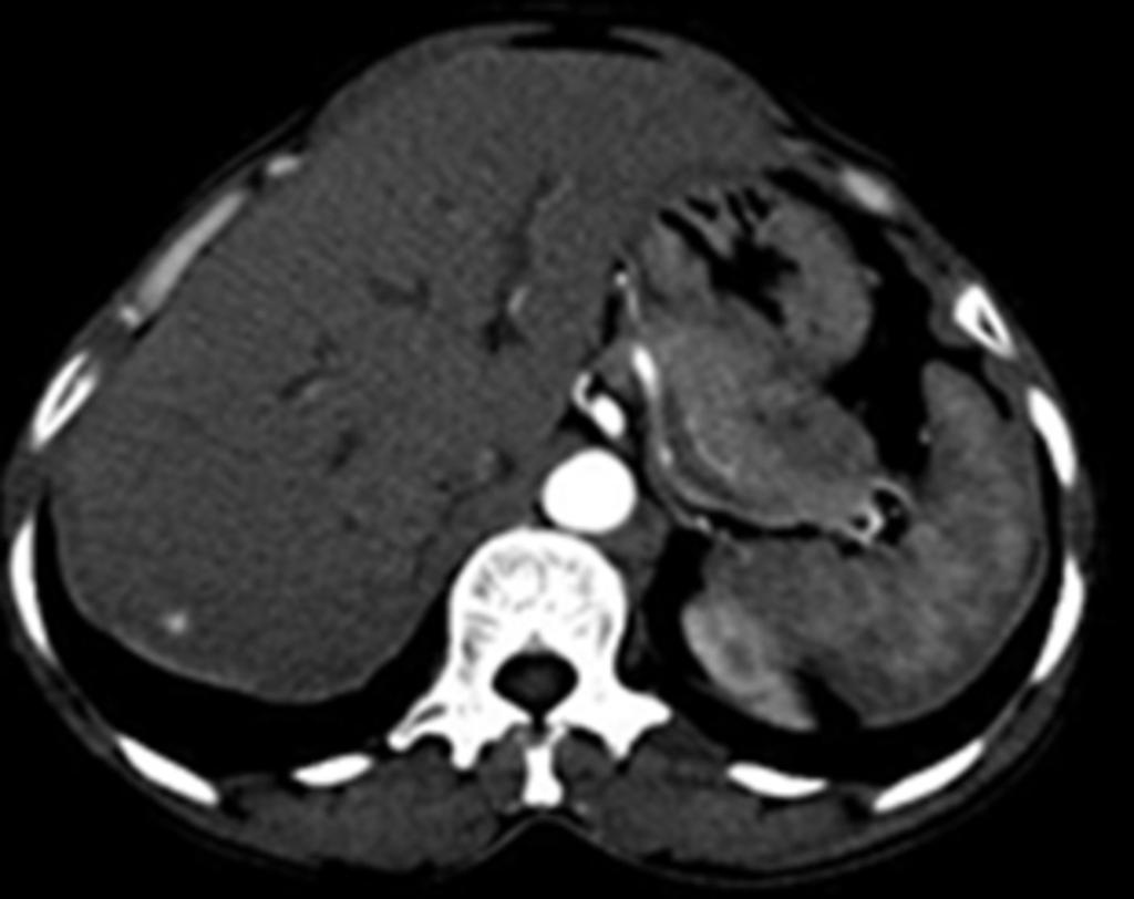 Fig. 25: Axial CECT image showing the retroperitoneal