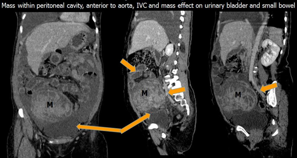 Fig. 28: Coronal and Sagittal CECT images of a mesenteric mass within peritoneal