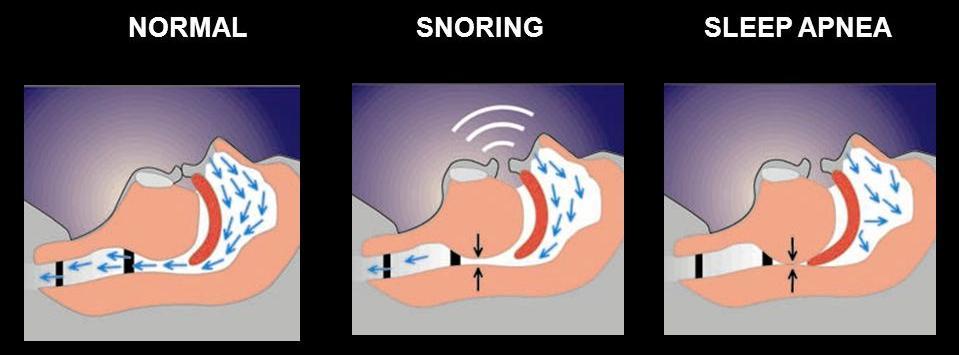 Sleep apnea syndrome (SAS) Prevalence in acromegaly: