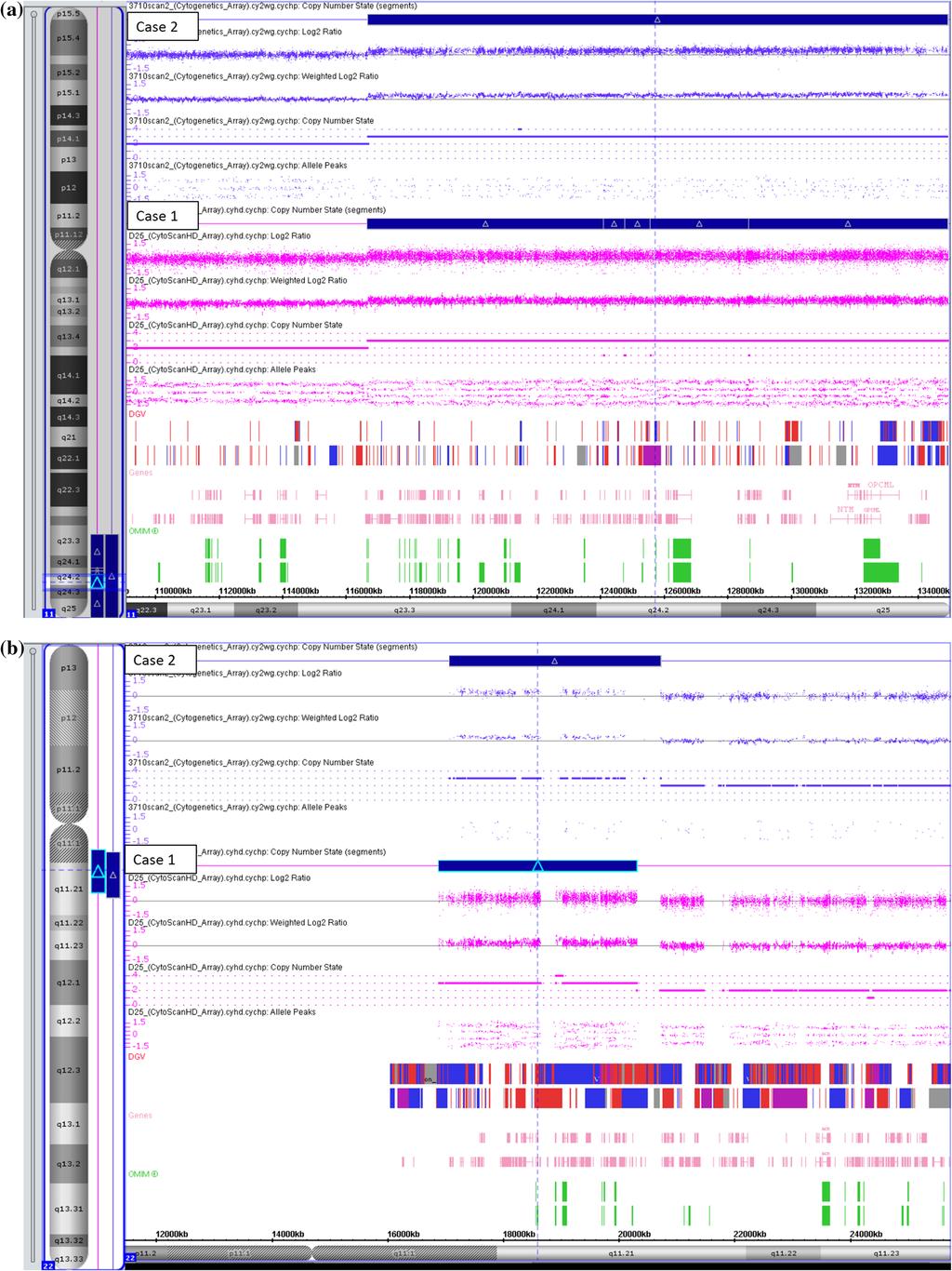 208 Deepti Saxena et al. Figure 3. (a) Cytogenetic microarray showed gain of 18Mb on chromosome 11 ([arr[hg19] 11q24.