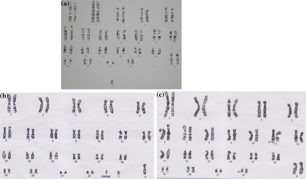 Case series of Emanuel syndrome 209 Figure 4. (a) Karyotype of case II showing marker chromosome, 47,XX,+mar.