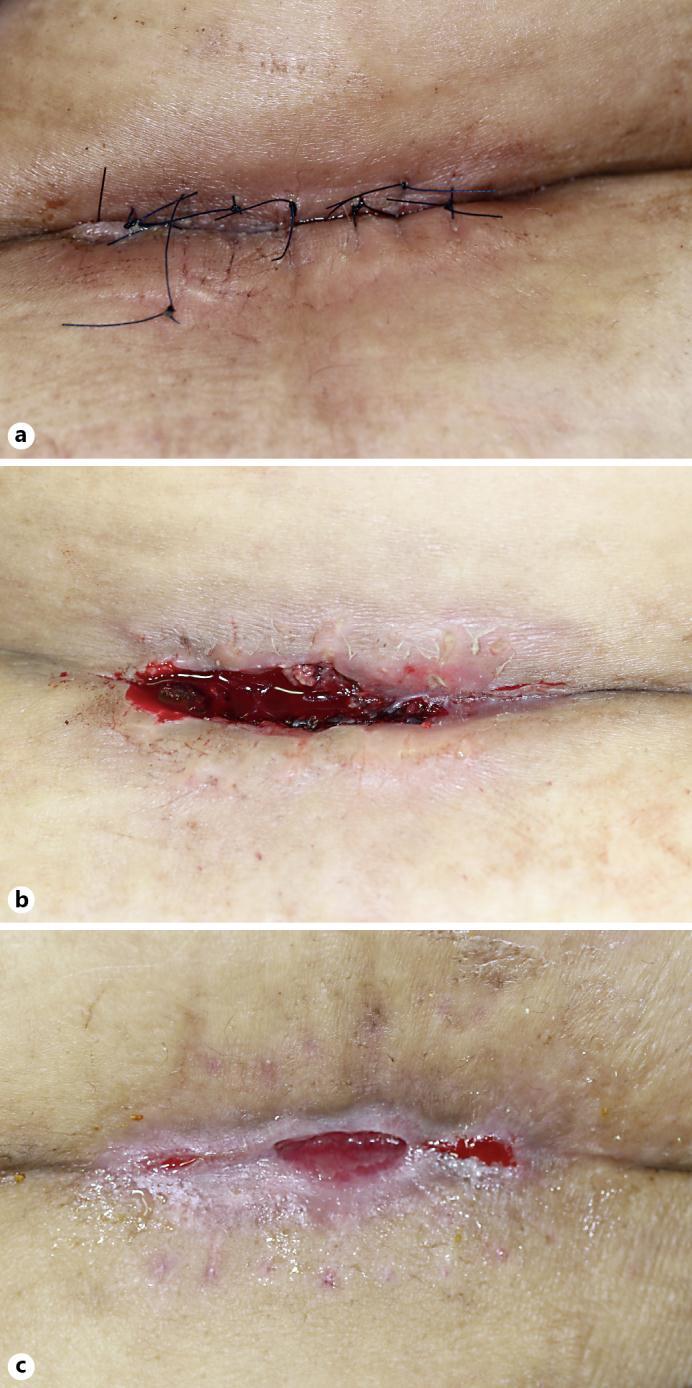 100 Fig. 1. Clinical appearance of the postoperative wound on the patient s lower abdomen.