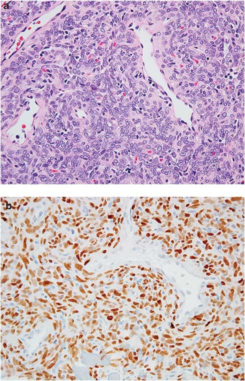 S56 Novel markers for soft tissue tumors Figure 12 STAT6 expression in solitary fibrous tumor.