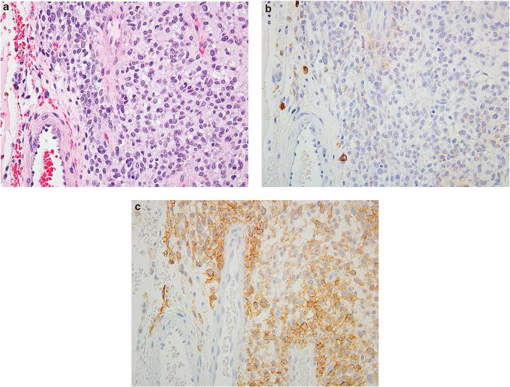 Novel markers for soft tissue tumors S57 Figure 13 DOG1 (discovered on GIST1) expression in gastrointestinal stromal tumor.