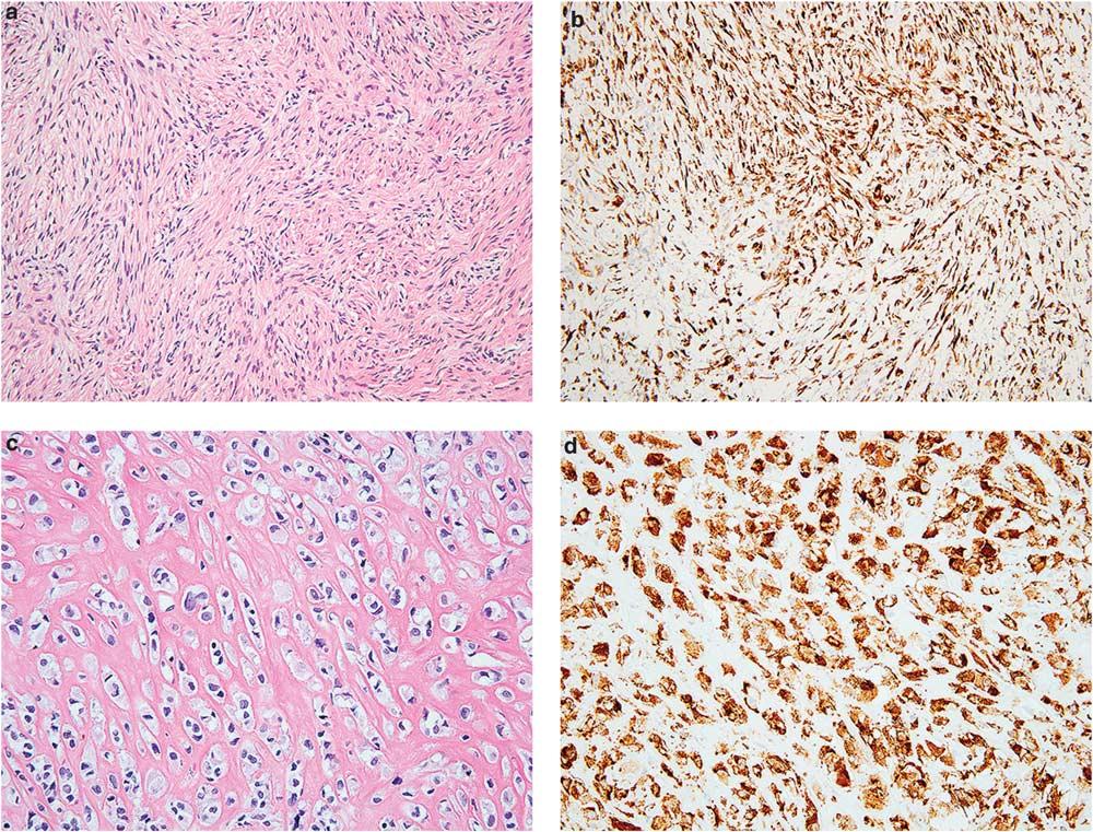 Novel markers for soft tissue tumors S59 Figure 15 MUC4 expression in fibroblastic sarcomas.