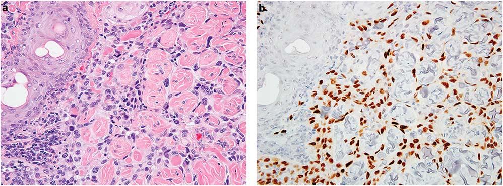 Novel markers for soft tissue tumors S49 Figure 1 Myogenin expression in rhabdomyosarcomas. (a) Alveolar rhabdomyosarcoma showing a solid growth pattern.