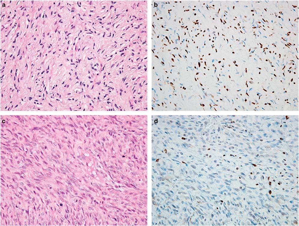 Figure 4 SOX10 (SRY-related HMG-box 10) expression in nerve sheath tumors. (a) Neurofibroma with buckled nuclei and prominent collagenous stroma. (b) SOX10 is positive in the Schwann cell component.