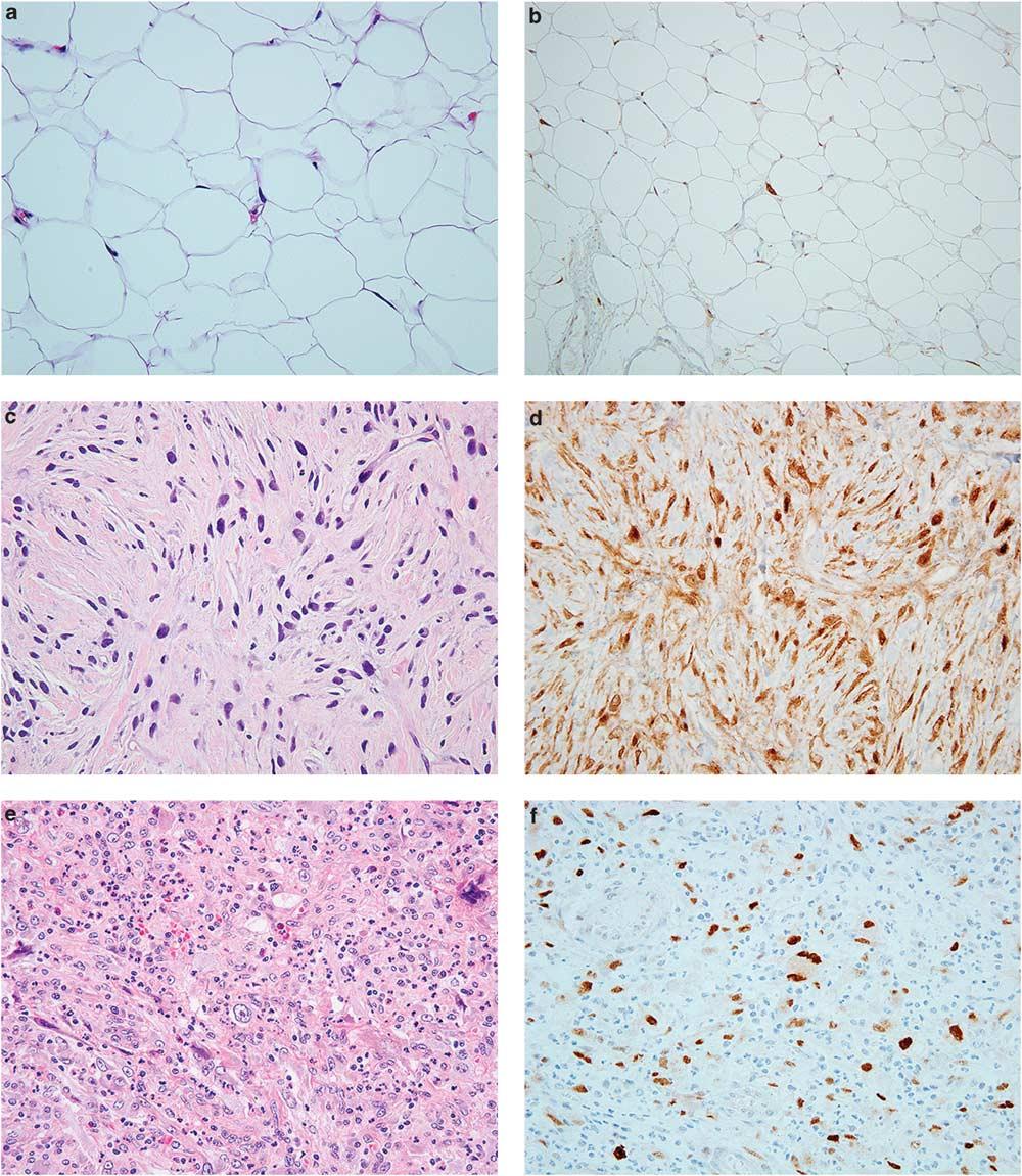 S52 Novel markers for soft tissue tumors Figure 7 MDM2 and CDK4 expression in liposarcomas. (a) Well-differentiated liposarcoma showing variation in adipocyte size and scattered hyperchromatic nuclei.