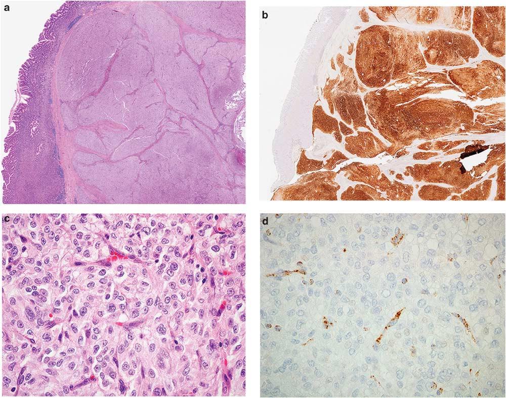 S54 Novel markers for soft tissue tumors Figure 9 Succinate dehydrogenase (SDH)-deficient gastrointestinal stromal tumor (GIST).