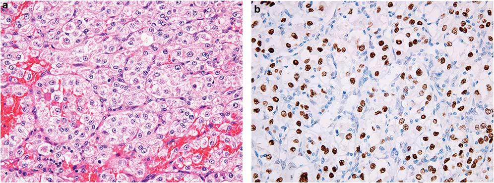 Novel markers for soft tissue tumors S55 Figure 10 TFE3 expression in alveolar soft part sarcoma.