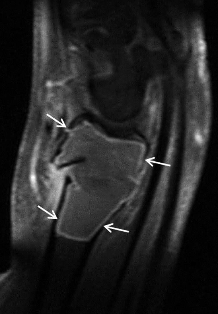 In cases with a benign pathologic fracture, the more frequently observed radiologic findings included a well-defined tumor margin with a sclerotic rim, no extra-osseous soft tissue mass, more
