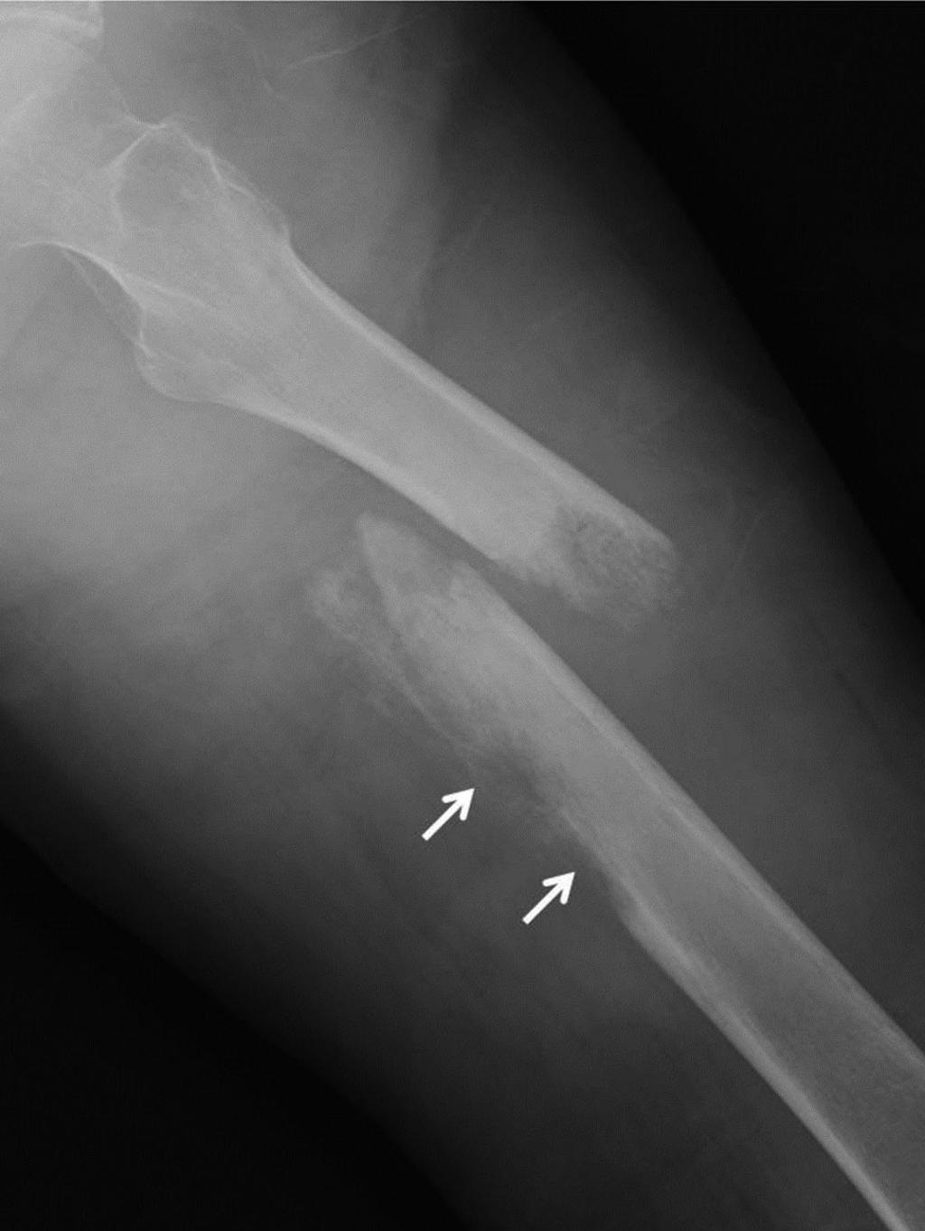 Bone Tumors with Fracture DISCUSSION Sarcoma is commonly associated with pathologic fracture, regardless of age, and this association is often related to a serious pathology (7, 8).