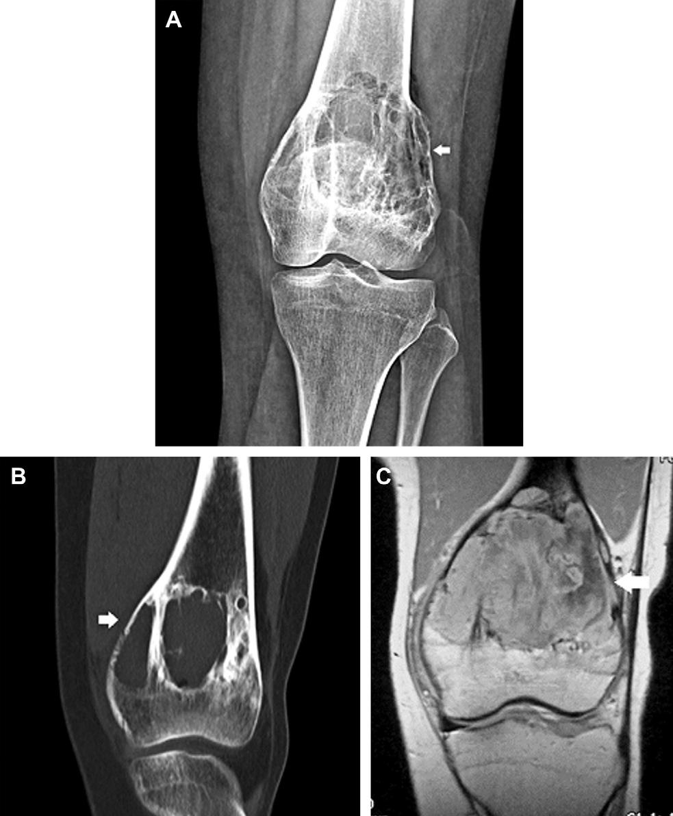1128 Motamedi & Seeger On radiography DF frequently has an aggressive appearance presenting as a lytic expansile lesion. The lesion may have internal trabeculation and a sclerotic margin.