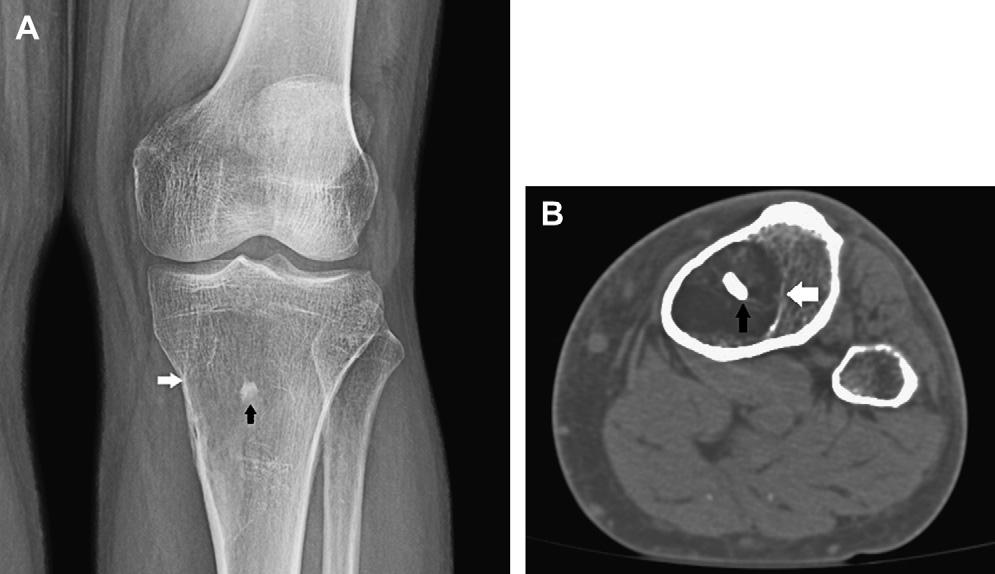 Benign Bone Tumors 1129 fracture. IL has been considered to be a very rare bone tumor, although a general increase in use of cross-sectional imaging has resulted in more frequent reporting.