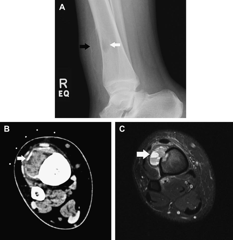Benign Bone Tumors 1133 Fig. 18. A 15-year-old boy with a subperiosteal distal tibia aneurysmal bone cyst (white arrow). (A) Lateral radiograph of the ankle.
