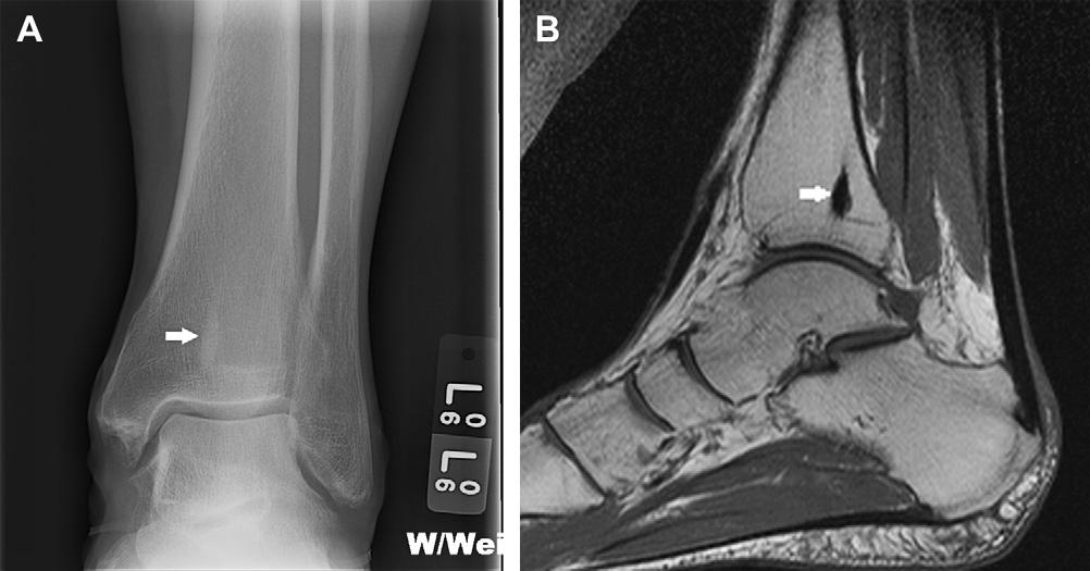 Benign Bone Tumors 1117 Fig. 1. A 58-year-old man with a bone island in the distal tibia (arrow). (A) Frontal radiograph of the ankle shows the elongated sclerotic focus in distal tibia.