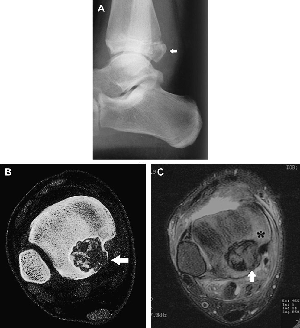 1120 Motamedi & Seeger Fig. 4. A 13-year-old boy with an osteoblastoma of distal tibia. (A) Lateral radiograph demonstrates the expansile lesion of the distal tibia (arrow).