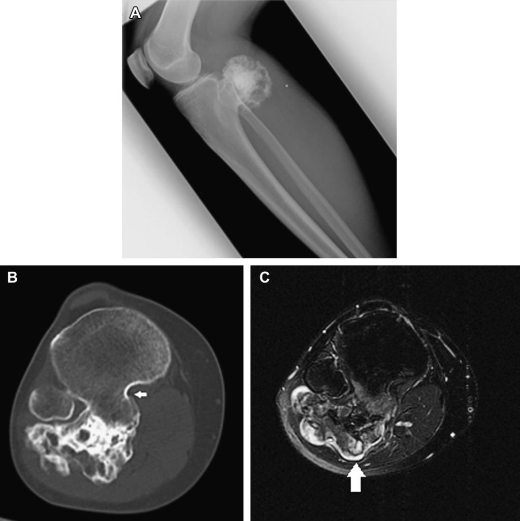 Benign Bone Tumors 1121 Fig. 5. A 35-year-old woman with a large osteochondroma arising from the posterior cortex of the proximal tibia. (A) Lateral radiograph.