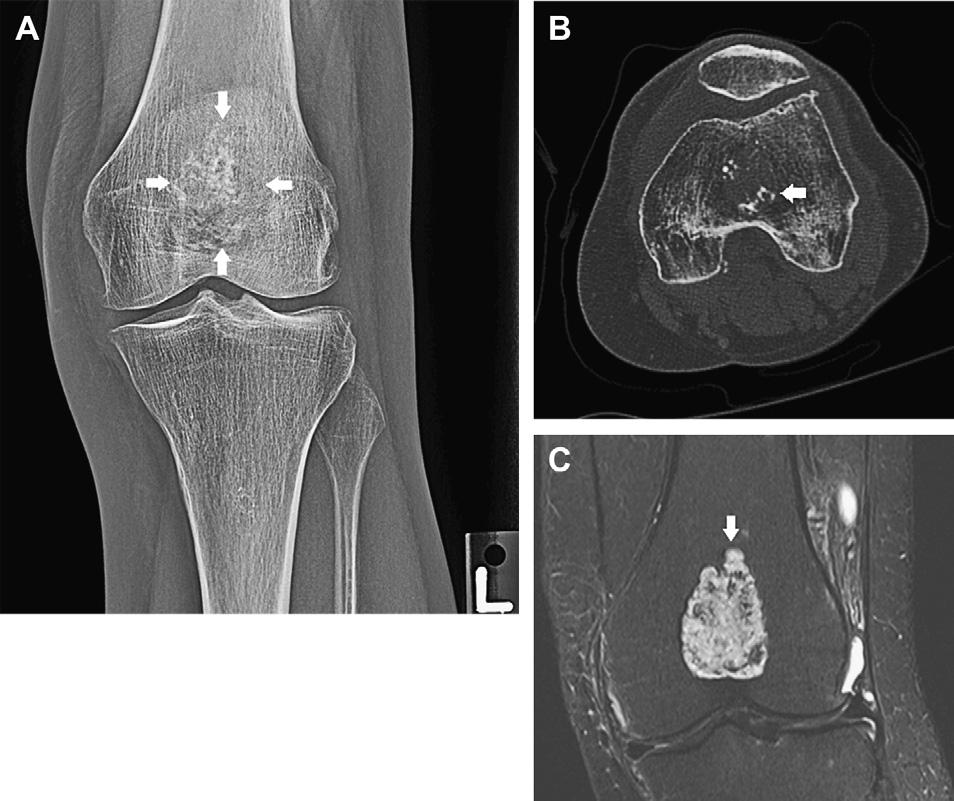1122 Motamedi & Seeger Fig. 6. A 57-year-old woman with an incidental enchondroma of the distal femur. (A) Anteroposterior radiograph of the knee shows a central mineralized lesion (arrows).
