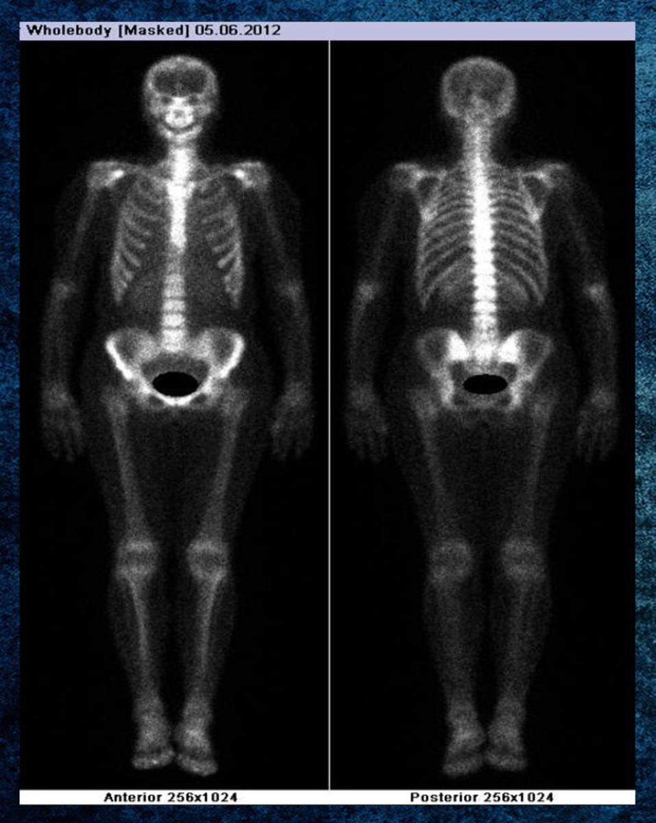 Fig. 9: 99mTc-HDP whole body bone scan, showing a suspicious increased focal uptake of the radiotracer