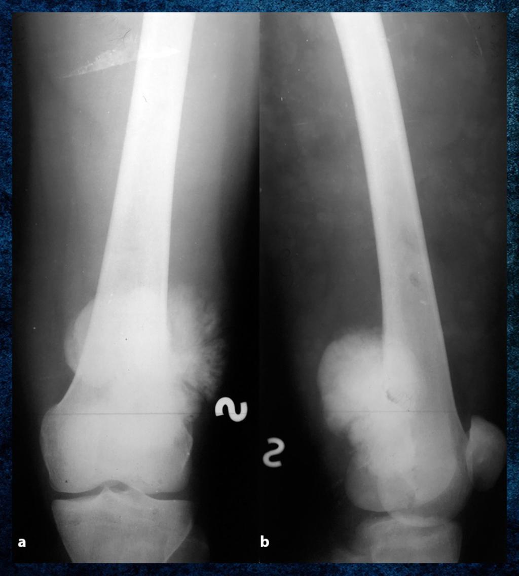 Fig. 11: AP radiograph showing a lytic-type osteosarcoma of the proximal left humerus showing intense destruction and marked involvement of the soft tissues Department of Radiology, Orthopedics and