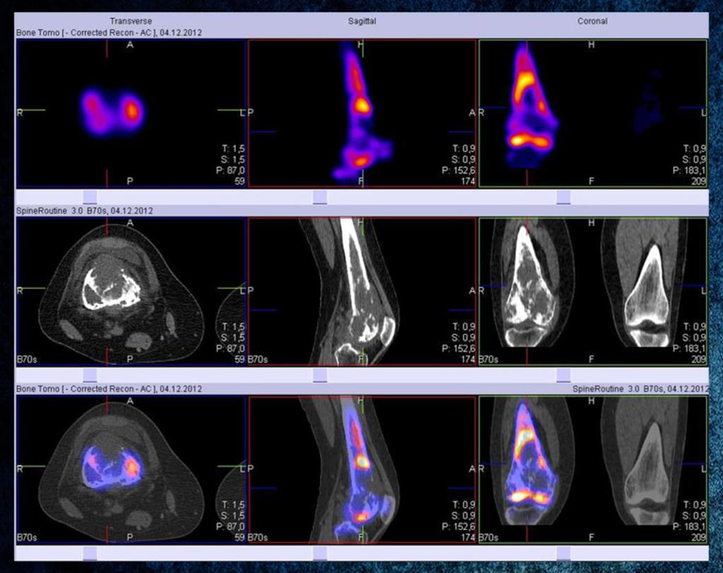 Fig. 17: Distal femur SPECT/CT shows a tumor with cortical bone destruction and soft tissue invasion in the area of high radiotracer uptake seen on previous