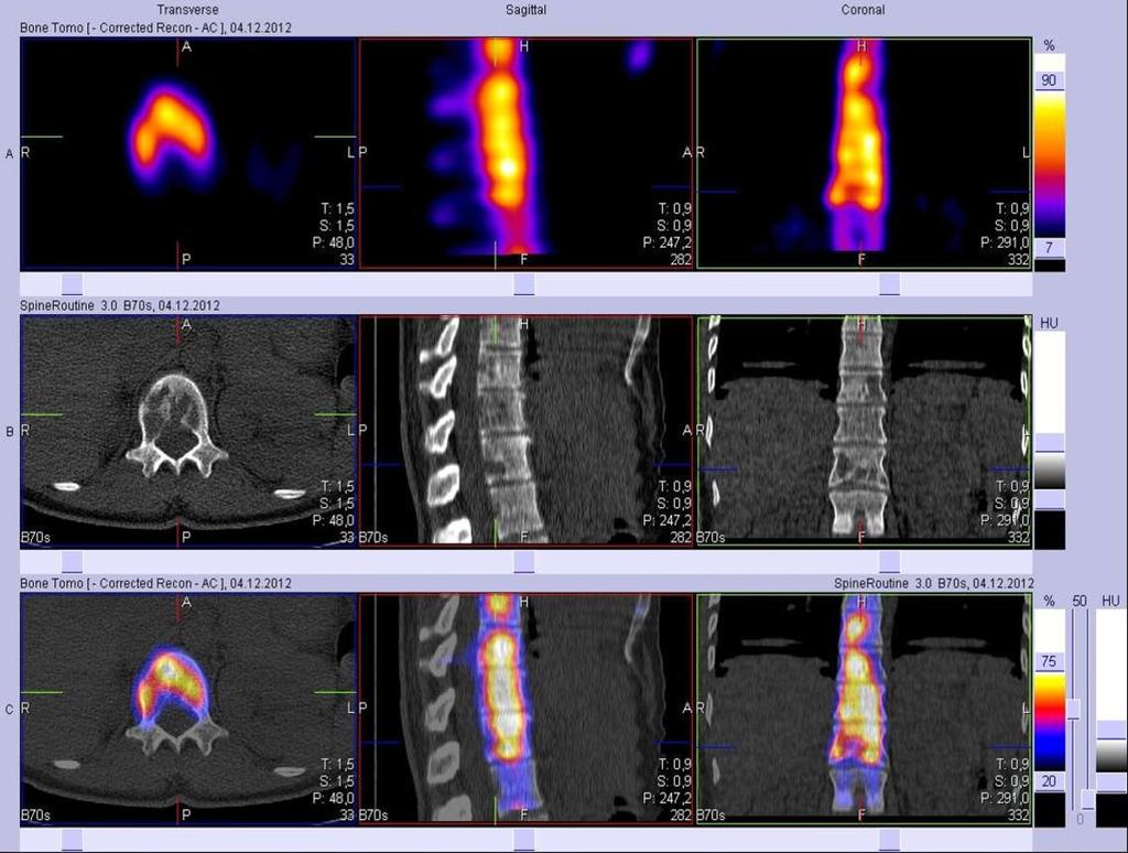 Fig. 18: SPECT/CT of the spine.
