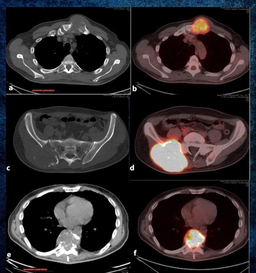 Fig. 34: a,b. CT scan showing mixed lytic-sclerotic metastases of the left iliac wing and vertebrae in a patient treated for Ewing sarcoma CT Clinic, Cluj-Napoca/Romania Fig.
