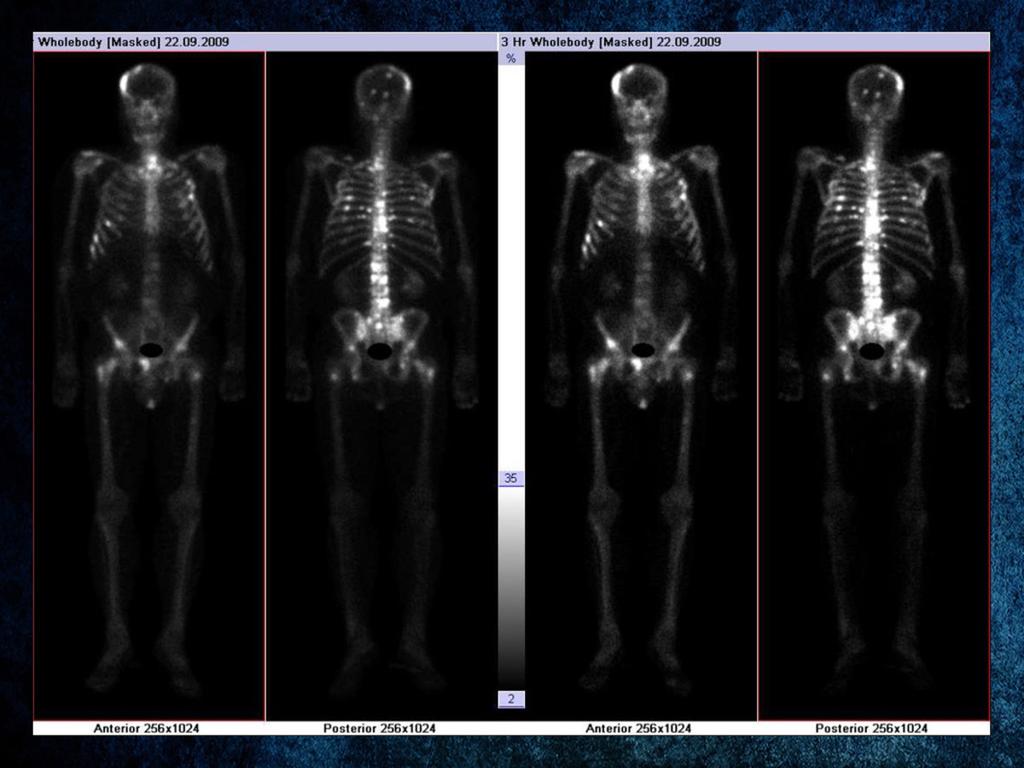 Fig. 36: 99mTc-HDP whole body bone scan, performed in the case of a patient with prostate andenocarcinoma, shows multiple focal areas of high radiotracer uptake, at the level of the