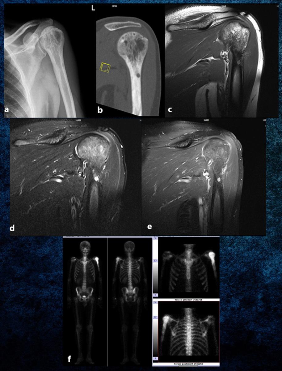 Fig. 41: Middle stage Paget's disease of the left proximal humerus. a.