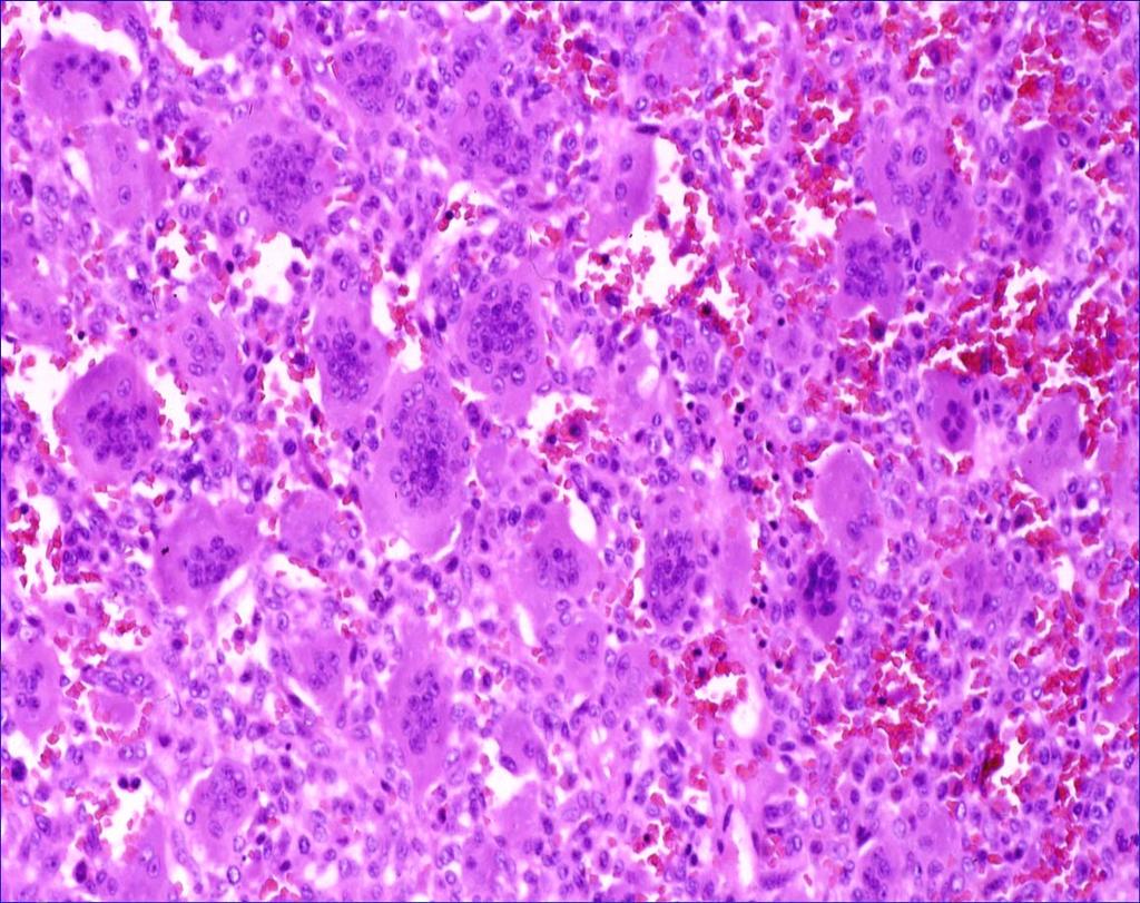 Giant cell tumor Histopathology: May have necrosis or secondary cyst formation Uniform pattern of growth with
