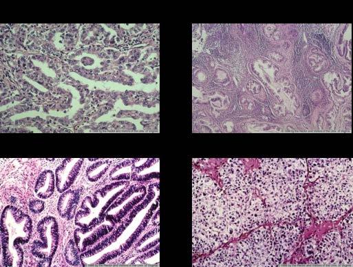 Classification of ovarian cancer is evolving to include molecular data High grade serous or endometrioid Low grade endometrioid Low grade serous Clear Cell Mucinous Genetic
