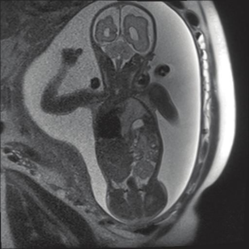 (b) T2-weighted: coronal MRI imaging at 28-week gestation showing left pulmonary bronchopulmonary foregut malformation and herniated bowel in the left  Figure 2: Chest radiograph showing left