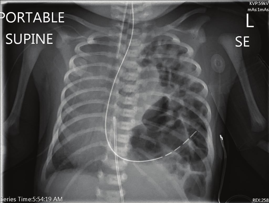 Once the hernia was reduced, the pulmonary sequestration was identified as being extralobar and was left in situ along the posterior mediastinum.