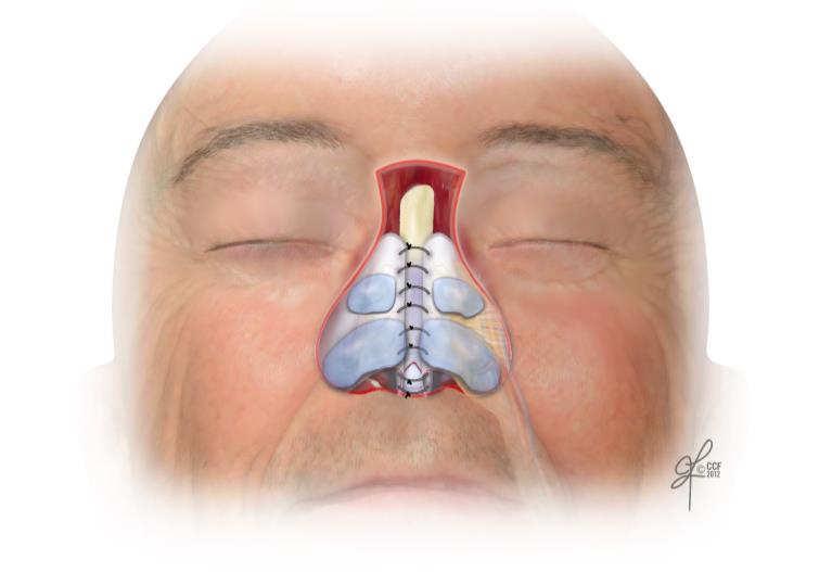 Vascularized Nasal Lining Free tissue transfer and nasal lining 1-3 Fasciocutaneous