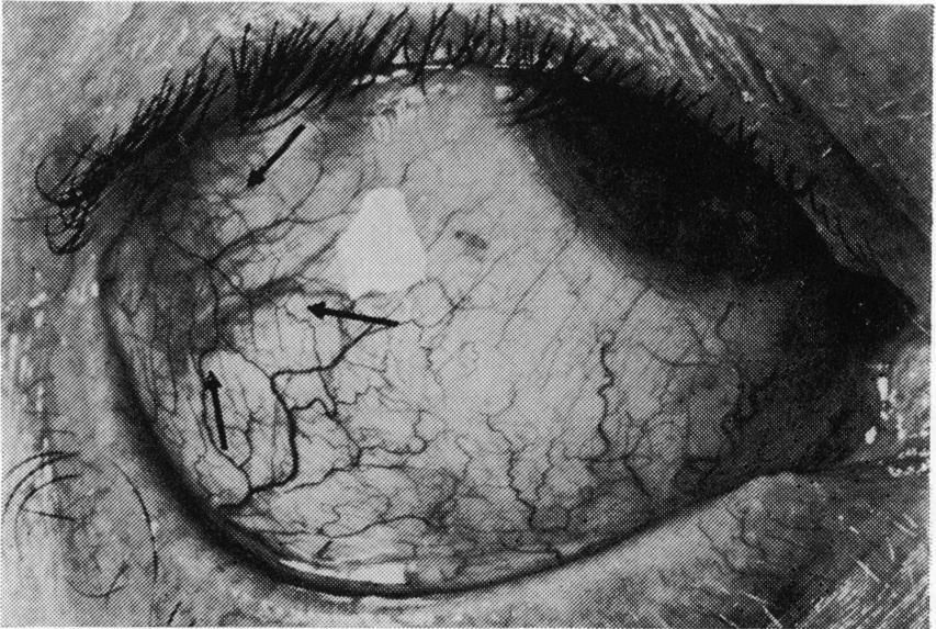 British Journal of Ophthalmology, 1978, 62, 330-335 An