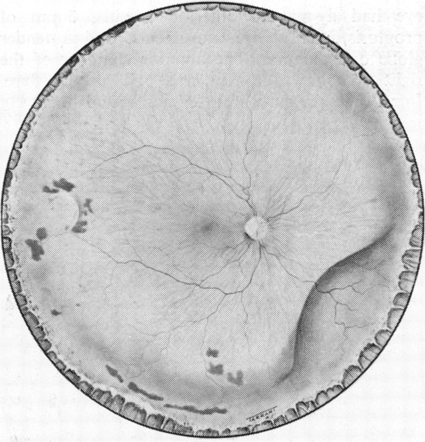 332 Fig. 5 Case 2. Fundus painting of the right eye to show the location of the scleral 'abscess' temporal to the fovea, and the inferonasal and annular choroidal detachments Fig. 6 Case 3.