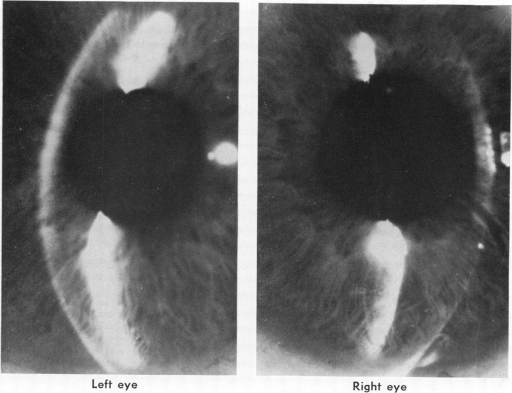 Angle-closure glaucoma secondary to posterior scleritis Left eye Right eye Fig. 7 Case 3.