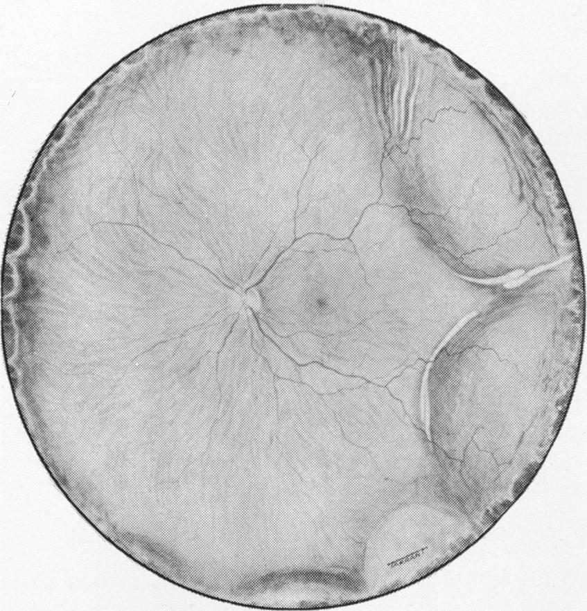 334 retinal detachment, diffuse choroidal and ciliary body thickening, secondary narrow-angle glaucoma, and mild proptosis (he also mentioned two other cases presenting with similar symptoms).
