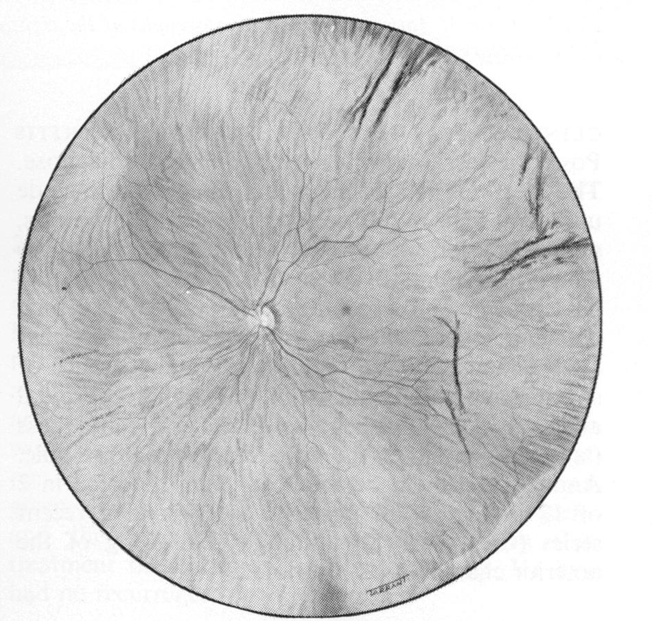 Fundus painting of the left eye to show the temporal choroidal effusion and the annular choroidal detachment M. P. Quinlan and R. A. Hitchings lymphocytes, reticulum cells, and plasma cells.
