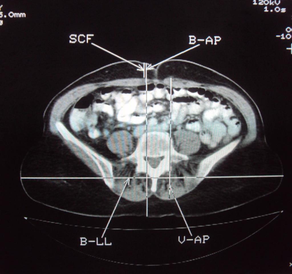 Fig. : Axial CT image at the level of the umbilucus: measurement of the subcutaneous fat (SCF), body